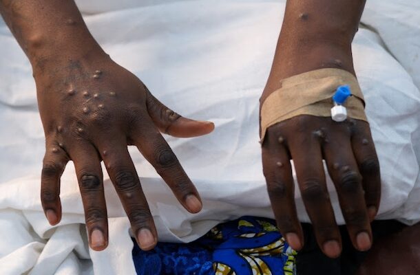 Ghana Health Service confirms 3 new fatalities from Mpox