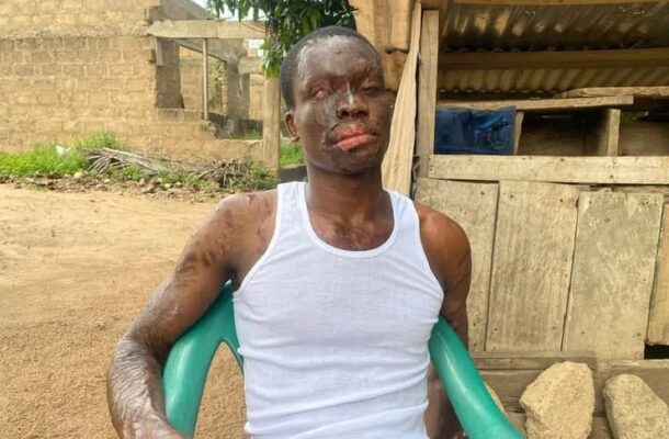 Aspiring journalist blinded in alleged acid attack appeals for help to restore sight